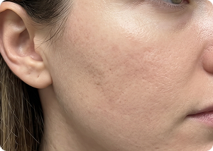 Microneedling after treatment