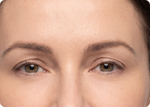 Wrinkle relaxers after treatment