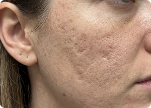 Microneedling before treatment