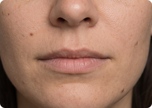 Lip augmentation before treatment