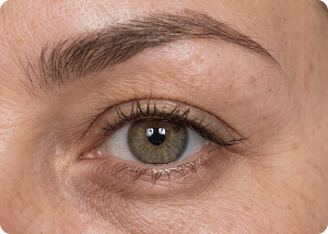 Under eye area before treatment