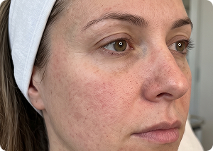 Préime DermaFacial before treatment