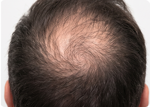 Hair restoration before treatment